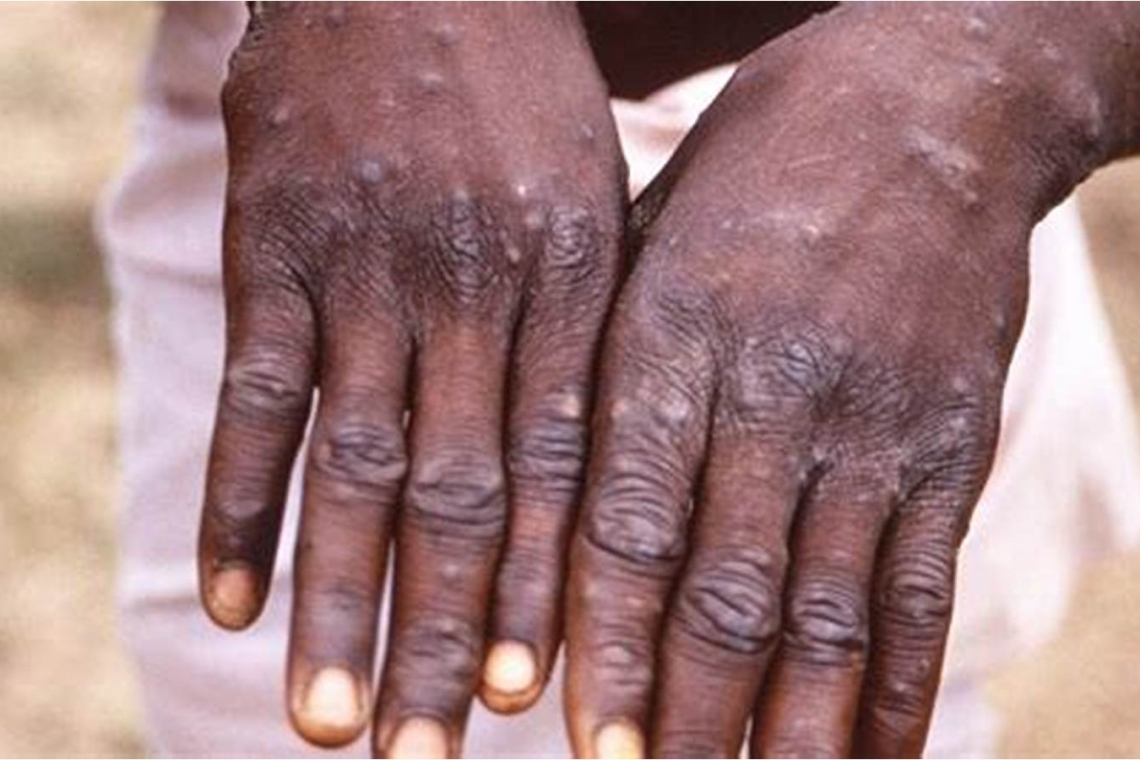 La République du Congo enregistre ses premiers cas de variole du singe